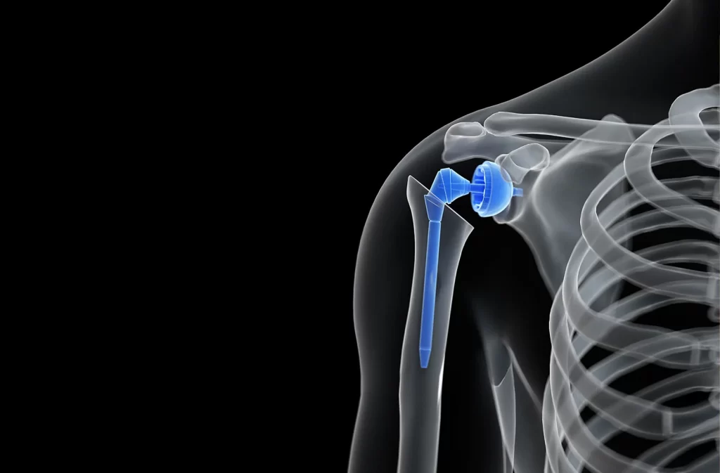 shoulder arthroscopy
