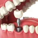 How Dental Implants Eliminate the Risk of Cavities and Offer Permanent Protection Against Tooth Decay