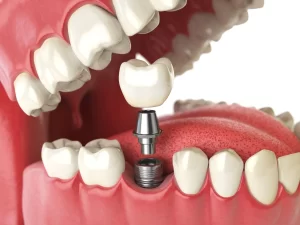 How Dental Implants Eliminate the Risk of Cavities and Offer Permanent Protection Against Tooth Decay
